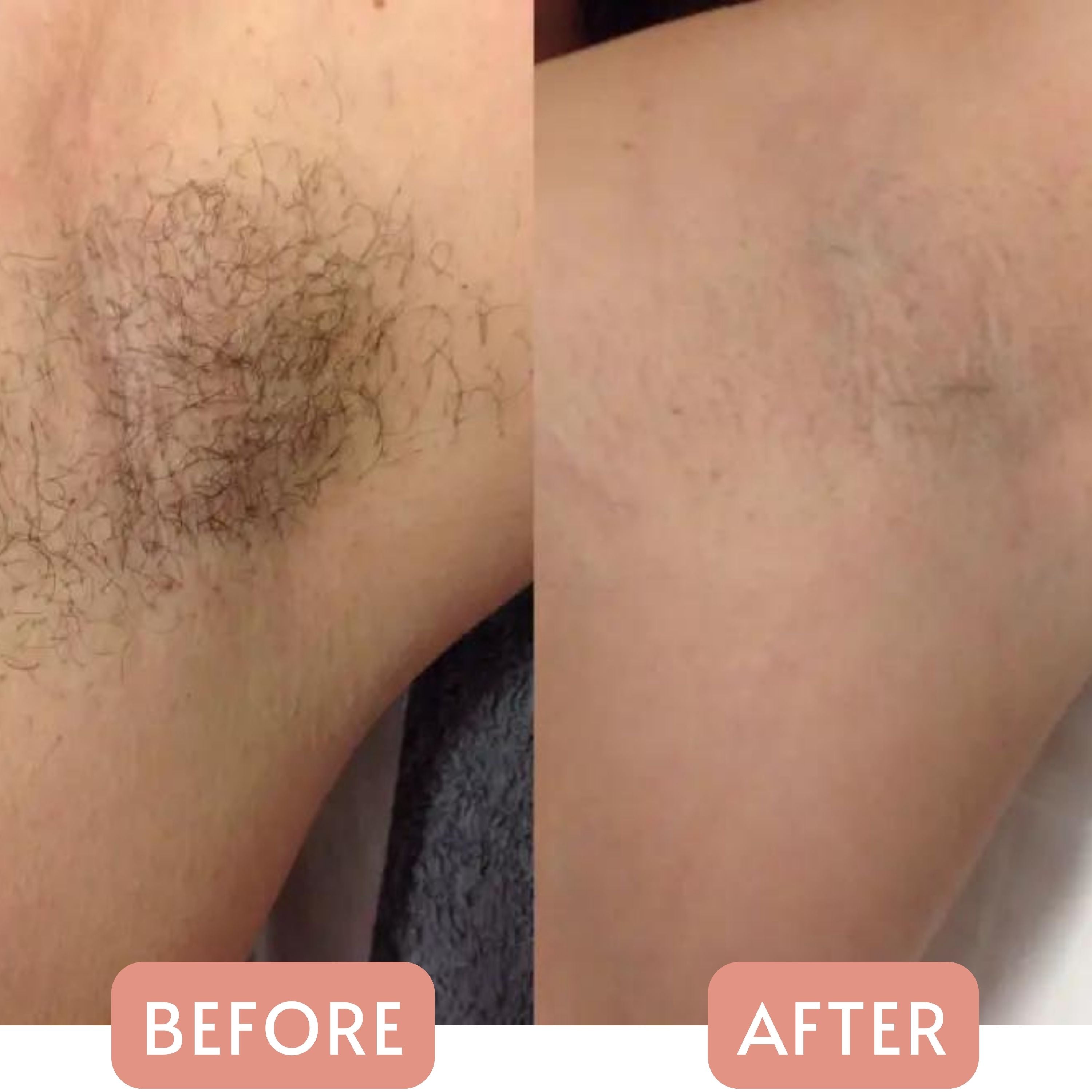 My Sheen Skin Before and After Results using IPL Laser Hair Removal At Home Device